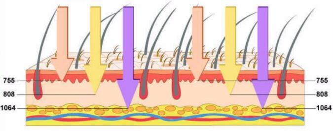 Diode laser with triple wavelength